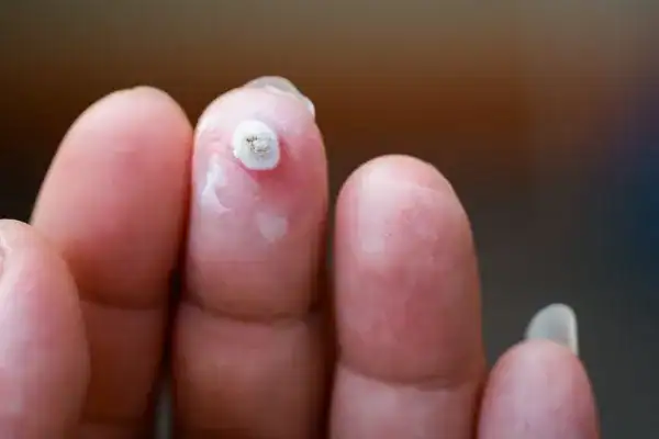 Image of white wart before cryopen treatment Andover