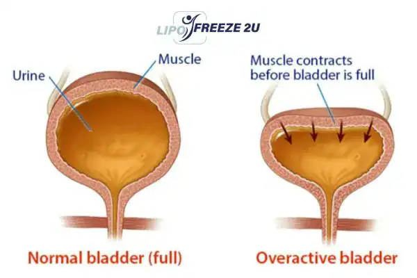 diagram of overactive bladder treatment Andover