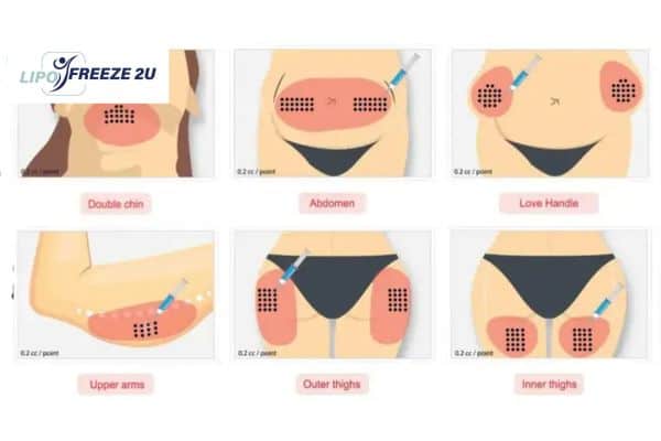 Benefits of Choosing Aqualyx for Fat Reduction Andover