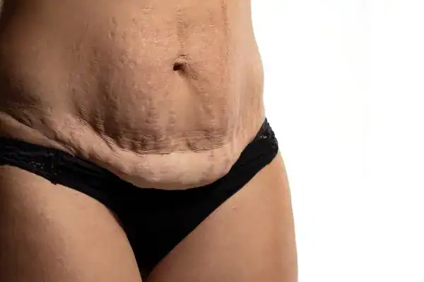 loose skin after weight loss injections Andover