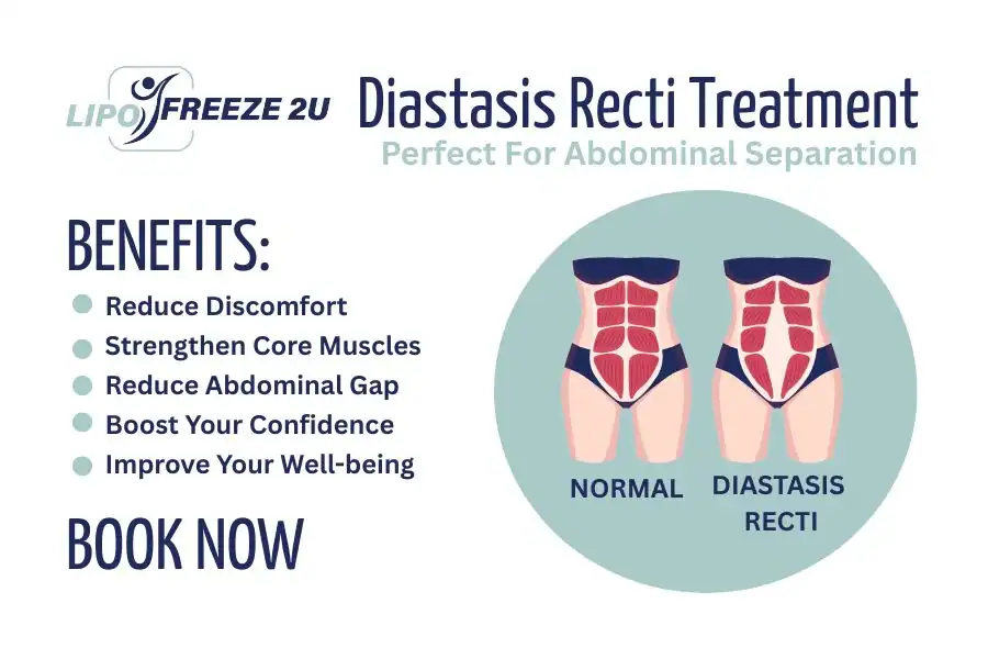 How Long Will It Take to See Improvements in Diastasis Recti Andover
