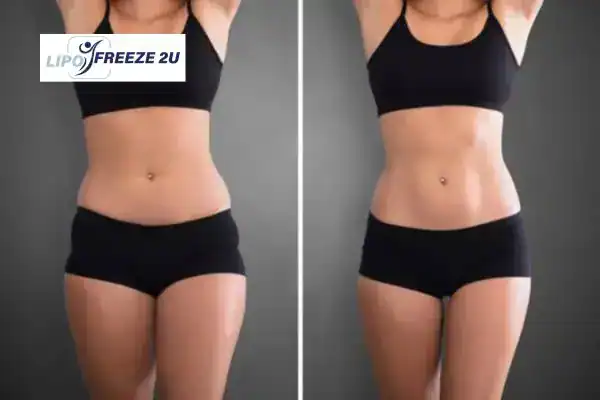 How Can LIPO FREEZE 2U Support Your Post-Pregnancy Body Recovery Andover?