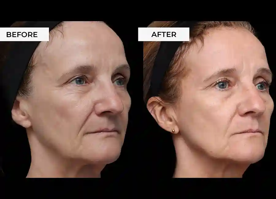 How Many RF Microneedling Sessions Will You Need to See a Difference Andover?